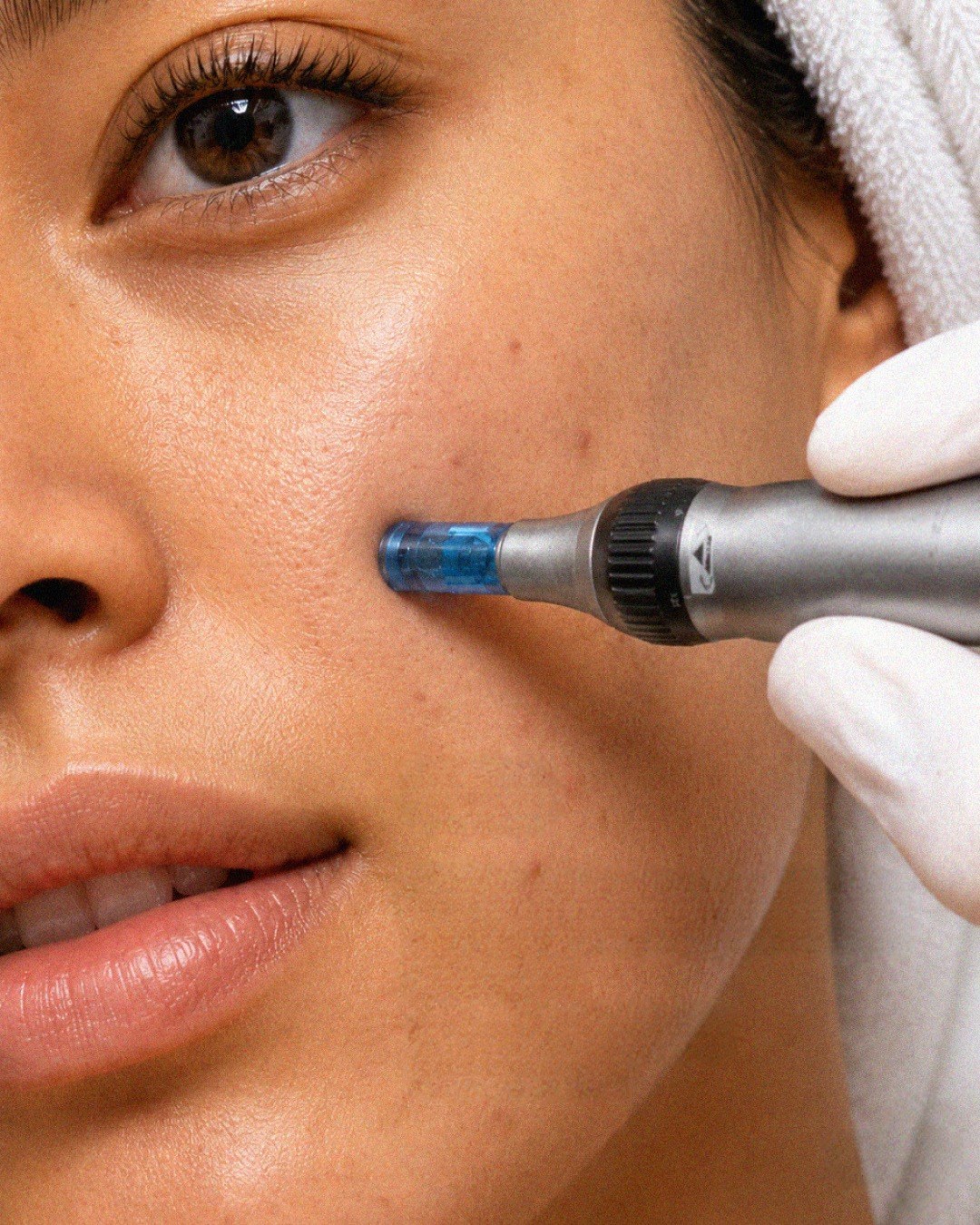 Microneedling